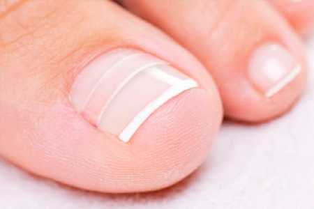 5 главных причин вросших ногтей