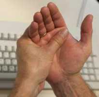 Но заметьте, что при данном заболевании воспаление пальцев на правой и левой руках чаще всего бывает не симметричным, тепоражаются, как правило, пальцы на одной руке а иногда сразу на двух руках, но тогда на одной руке воспаляются одни пальцы и суставы, а на второй руке совсем другие
